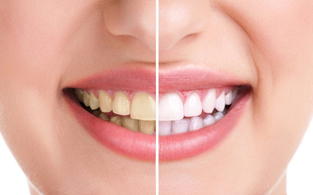 Teeth Whitening vs Veneers: Which One Is Right for Your Smile Goals?
