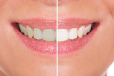 Teeth Whitening for Stained Teeth: Brighten Your Smile Safely and Effectively